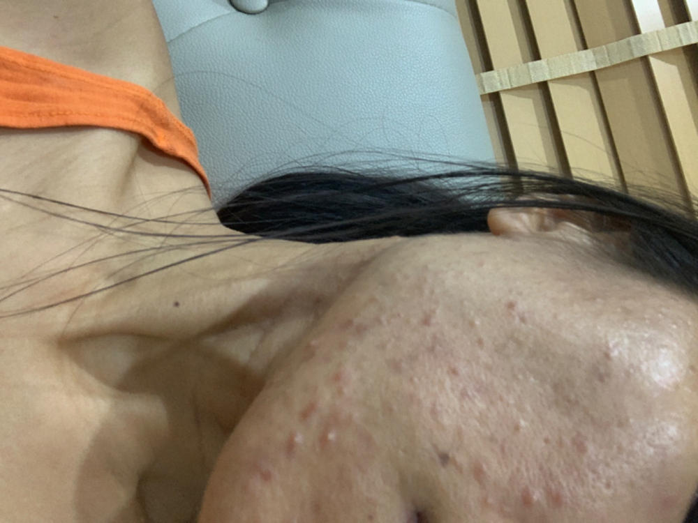 Tea Tree Concentrated Spot Treatment - Customer Photo From Phuong Phung